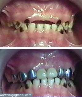 Протезирование дефектов зубных рядов несъёмными и съёмными конструкциями