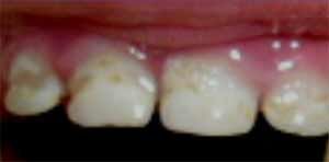 Изменение цвета эмали зубов
