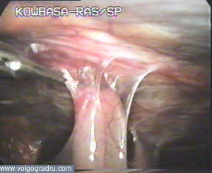 висцеро-париетальное сращение, участок тонкой кишки припаян к париетальной брюшине